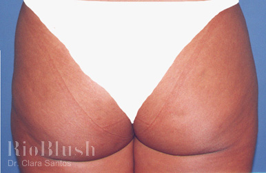 Stretch marks after